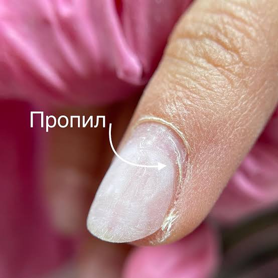 Пропил или птеригий? Полный гайд для мастера: как отличить, предотвратить и исправить